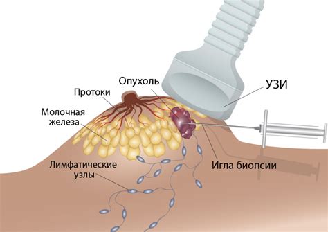 Пункционная биопсия для диагностики опухоли в голове