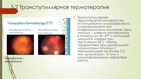 Работа глюкометра основана на использовании технологии безопасного инфракрасного излучения