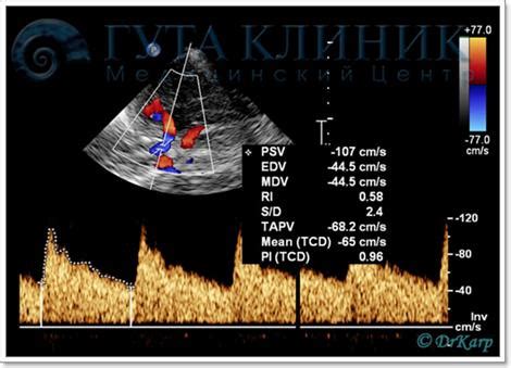 Работа и принцип ультразвукового дуплексного сканирования