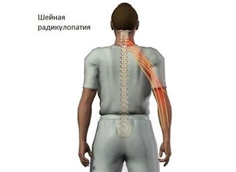 Радикулопатия шейного отдела позвоночника