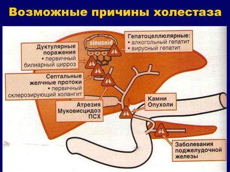 Развитие заболевания желчного пузыря под воздействием кофе