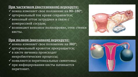 Развитие кисты яичника