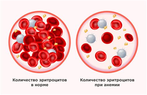 Различные виды анемии и их влияние на гемоглобин