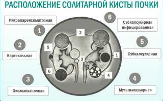 Различные методы лечения почечных кист