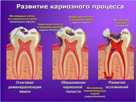 Разрушение зубов и образование кариеса