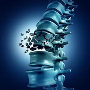Разрушение позвоночника: какие последствия может принести небрежное отношение к своему здоровью?