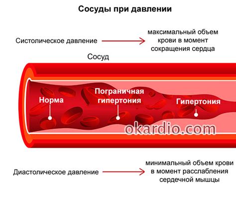 Разрыв сосудов: основная причина кровотечения при гипертонии