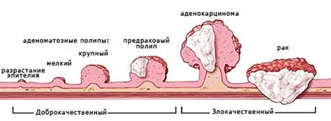 Раковые опухоли как источник воспаления