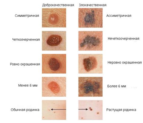 Раннее возникновение родинок при наследственности