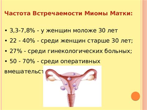 Распространенность миомы среди женщин