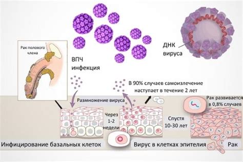 Распространенные симптомы ВПЧ у мужчин