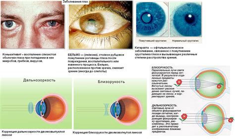 Расстройства зрения и заболевания глаз