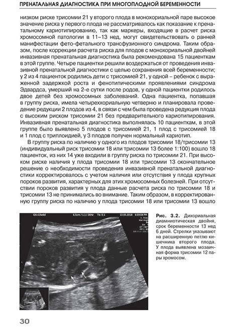 Расчет даты родов при многоплодной беременности