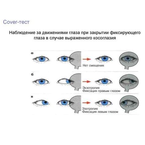 Реабилитация после лечения косоглазия у взрослых