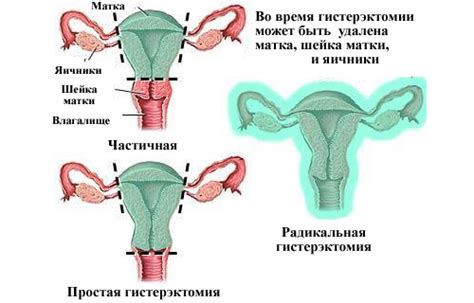 Режим дня для восстановления матки