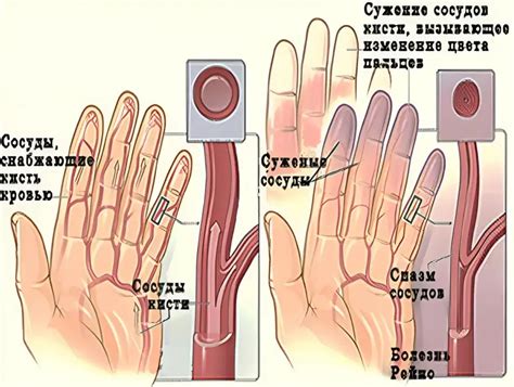 Рейно-симпатическая дистрофия