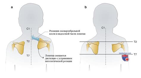 Рекомендации по профилактике и укреплению лопаток у ребенка