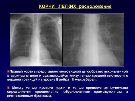 Рентгенография и её место в сканировании легких