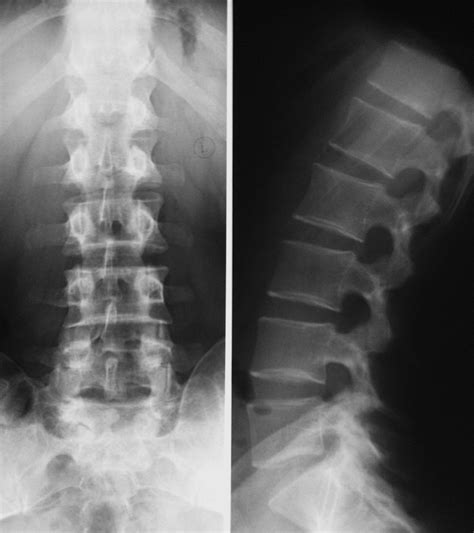 Рентгенография поясничного отдела позвоночника