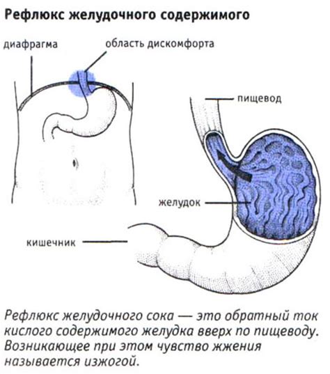 Рефлюкс желудочного содержимого