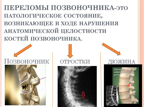 Риск нарушения целостности позвоночника