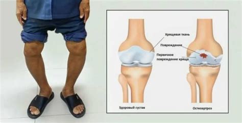Риск развития остеоартроза