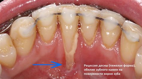 Роль зубной щетки в восстановлении десны