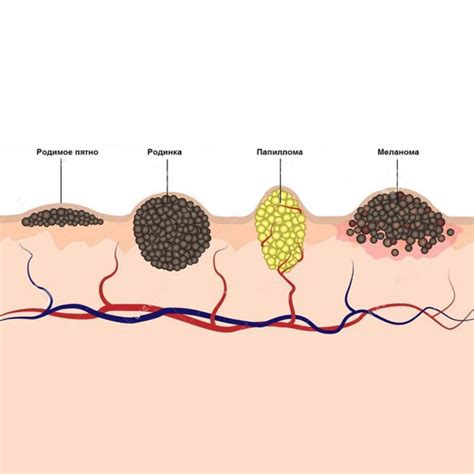 Роль повреждений и травм в формировании родинок на коже