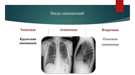 Роль флюорографии в диагностике пневмонии