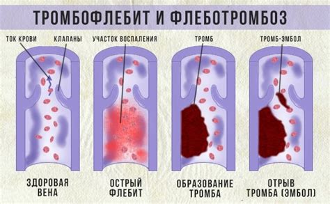 Рубцовое образование на сосудах