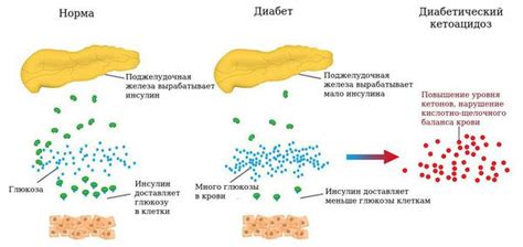 Сахарный диабет и кетоацидоз: общая информация