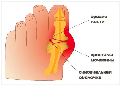 Сельдь и подагра: устранение проблемы медикаментозно