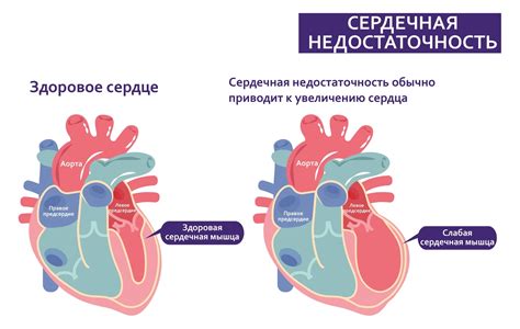 Сердечная недостаточность