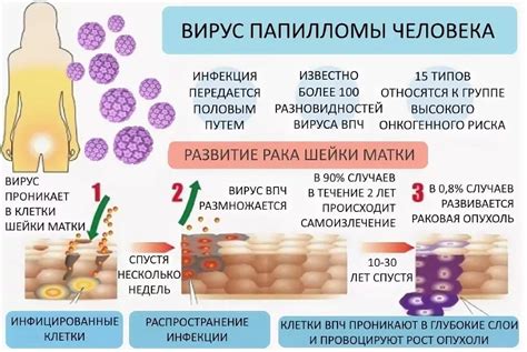 Симптомы ВПЧ у мужчин