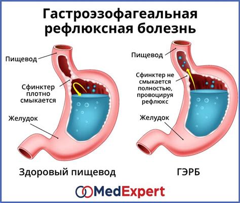 Симптомы гастроэзофагеального рефлюкса и черные вкрапления в кале