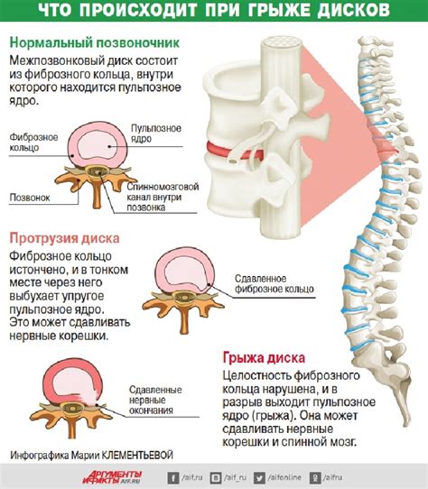 Симптомы грыжи на позвоночнике