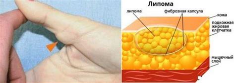 Симптомы и диагностика жировика