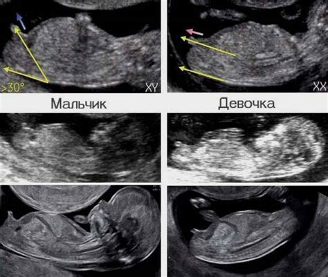 Симптомы и методы установления пола ребенка по узи