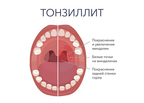 Симптомы и признаки гноя в миндалинах