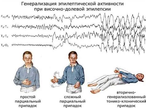 Симптомы и причины эпилепсии