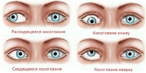 Симптомы косоглазия и раннее обнаружение