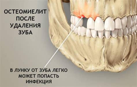 Симптомы остеомиелита зуба