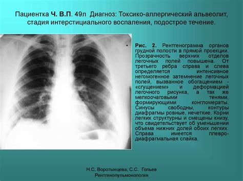 Симптомы патологий легочного рисунка