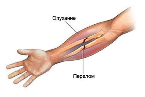 Симптомы перелома руки