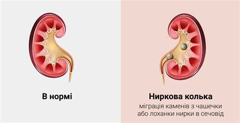 Симптомы почечной колики