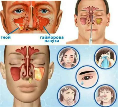 Симптомы простуды, сопровождающие зуд в носу