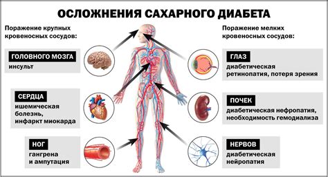 Симптомы сахарного диабета 2 типа