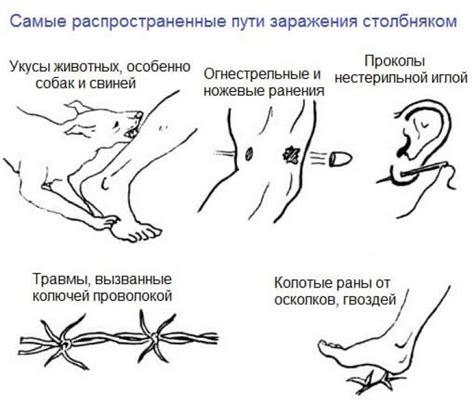 Симптомы столбняка и его основные причины