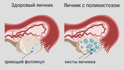 Симптомы тонкого эндометрия матки