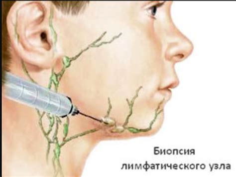 Симптомы увеличения лимфатического узла под мышкой: